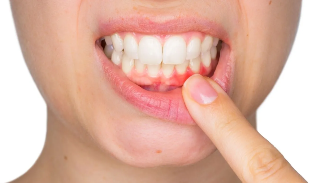 Desni vam ne prestaju krvariti? Razlog tome može biti nedostatak dva ključna vitamina